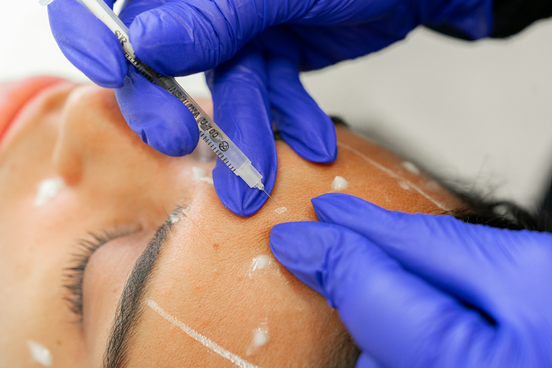 Physician administering injectable treatment at InstaDerm MD Clinics Mississauga