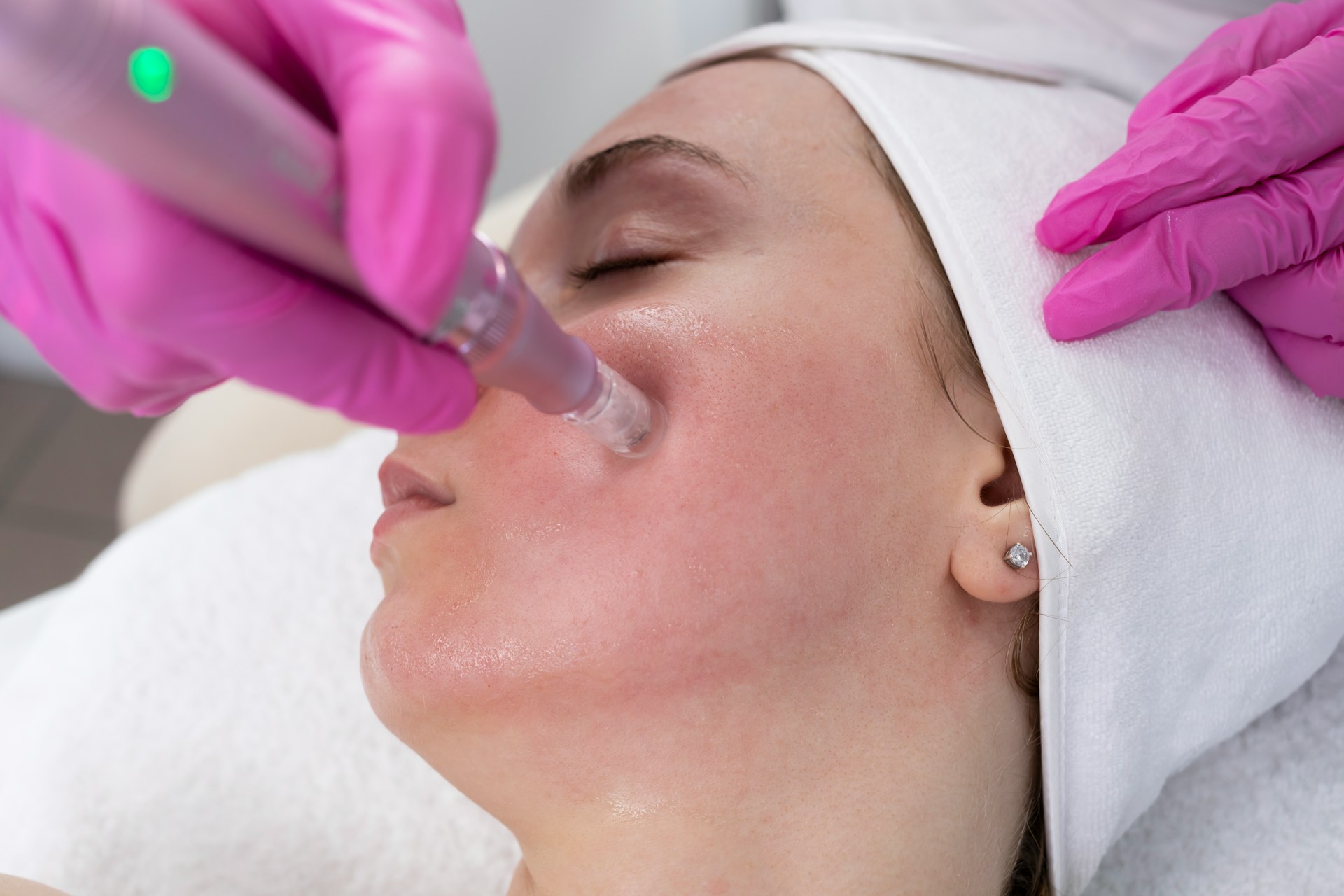 Microneedling treatment being done on a face